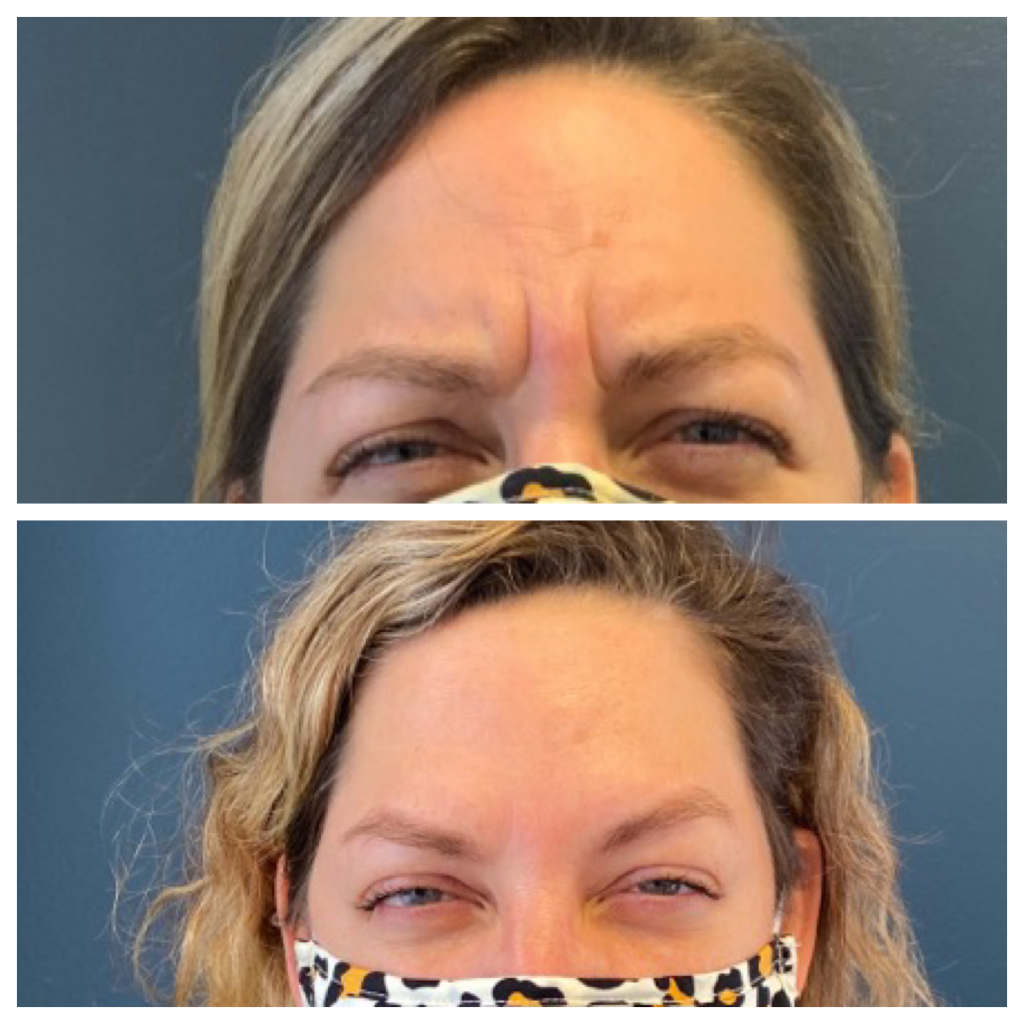 Botox - Frown Lines