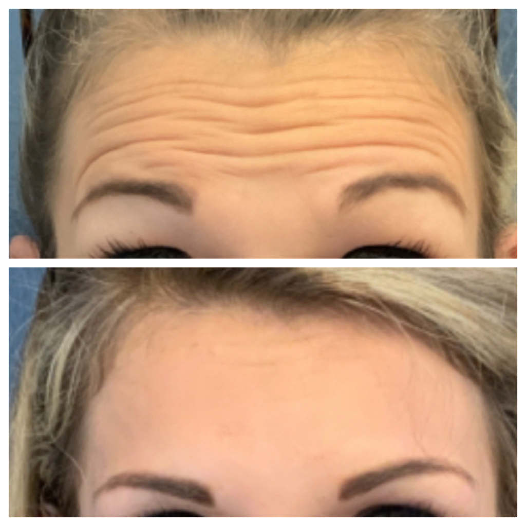 Dysport - Forehead