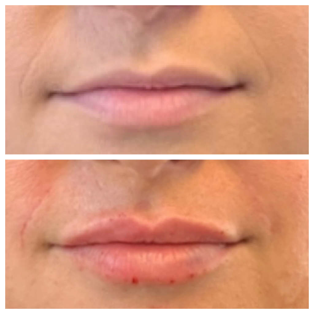 Lip Flip