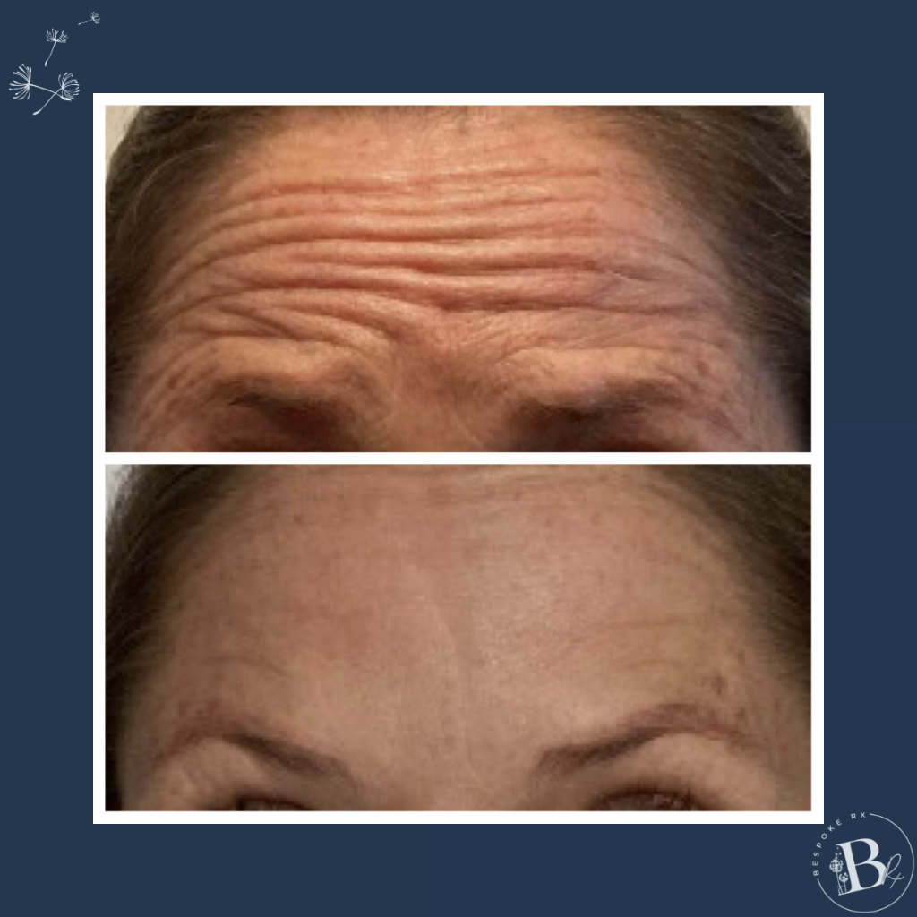 Dysport - Forehead