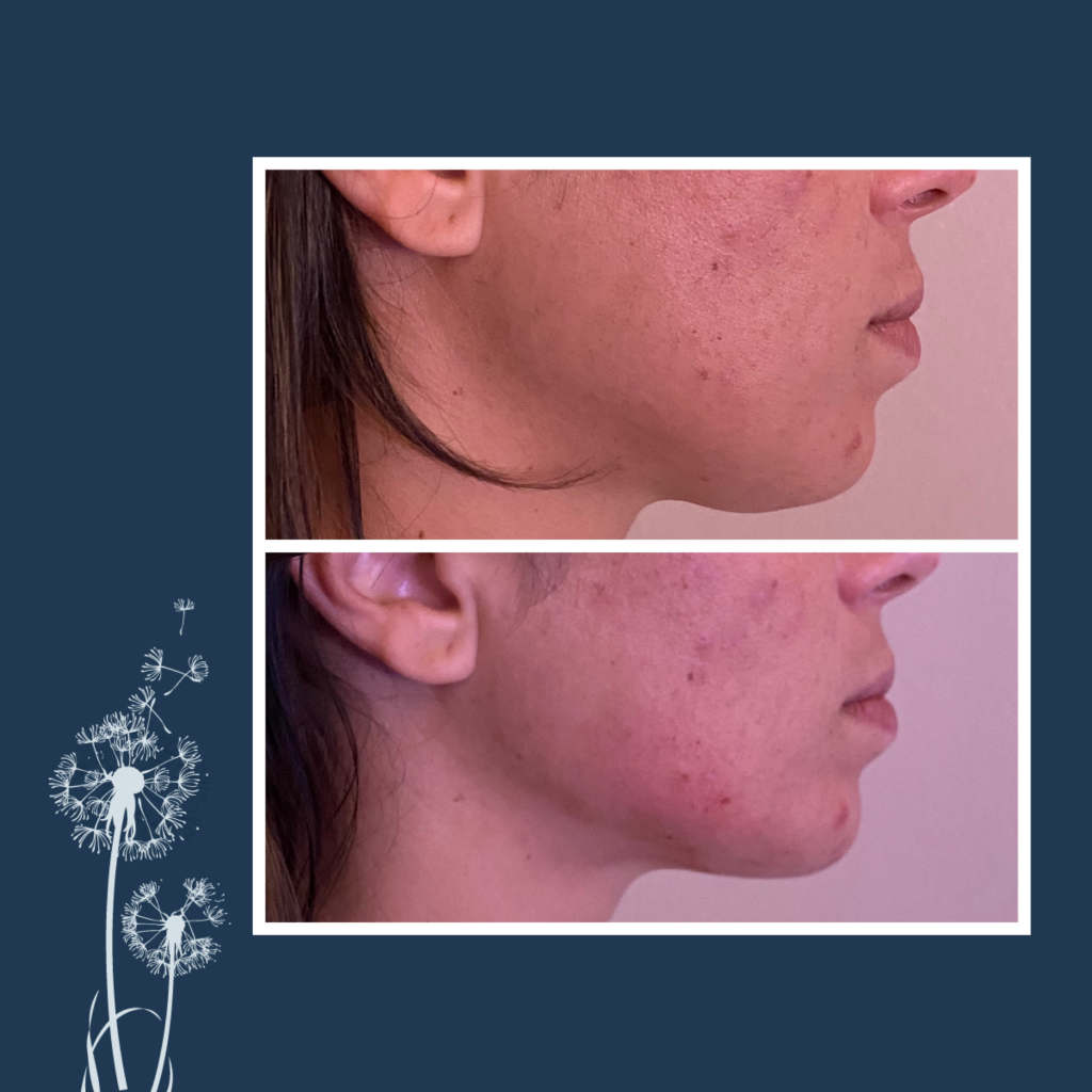 Filler Treatment