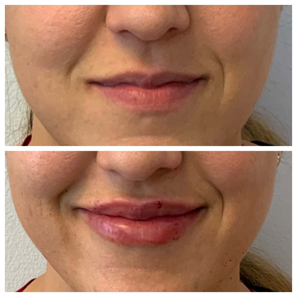 Before & AfterLip Filler Treatment with Restylane Kysse