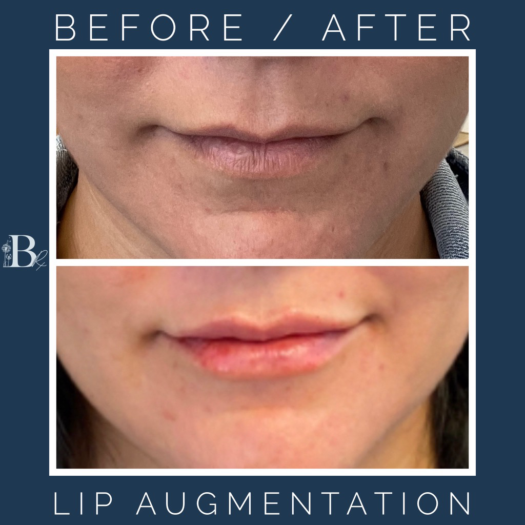 Lip Augmentation