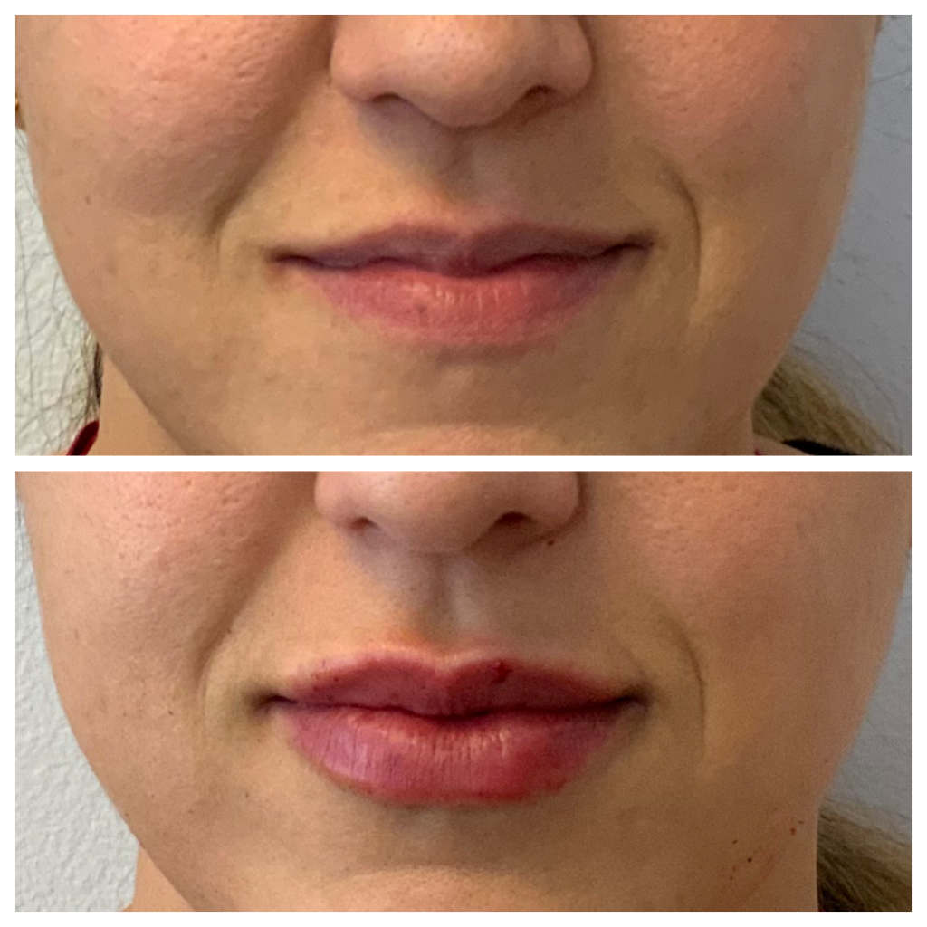 Lip Filler
