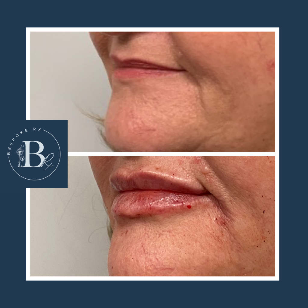 Lip Filler