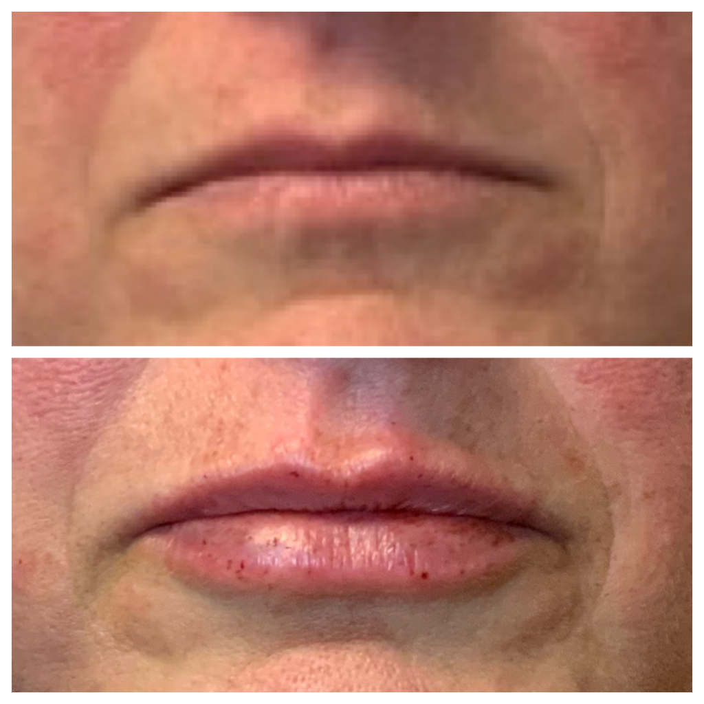 Lip Filler