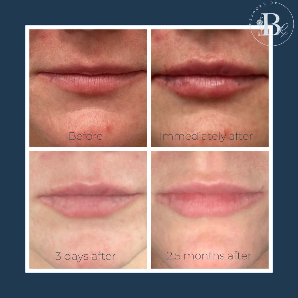 Lip Filler
