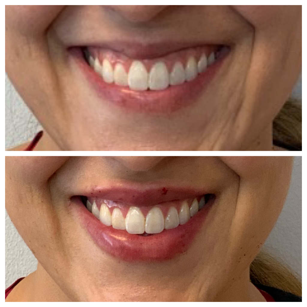Lip Filler Treatment with Restylane Kysse