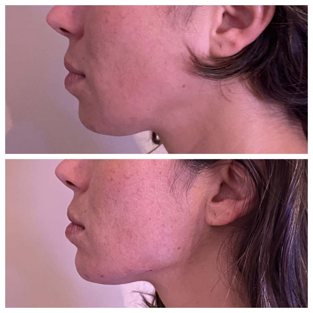 Filler Treatment