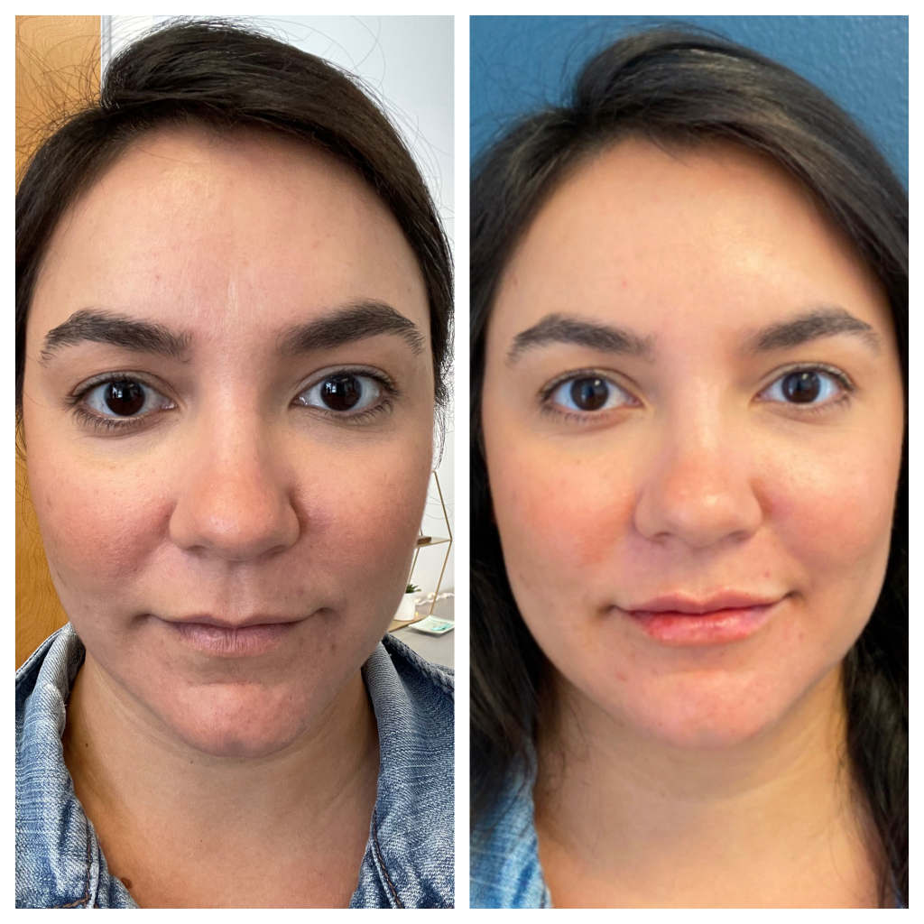 Lip Augmentation / Filler