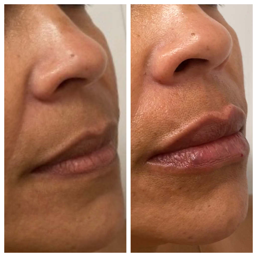 Lip Filler