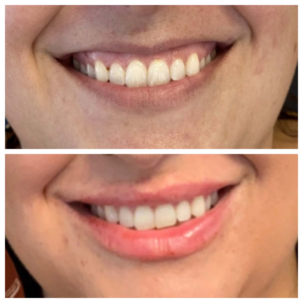 Lip Filler