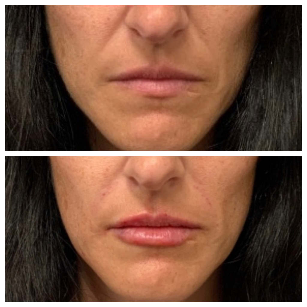 Lip Filler