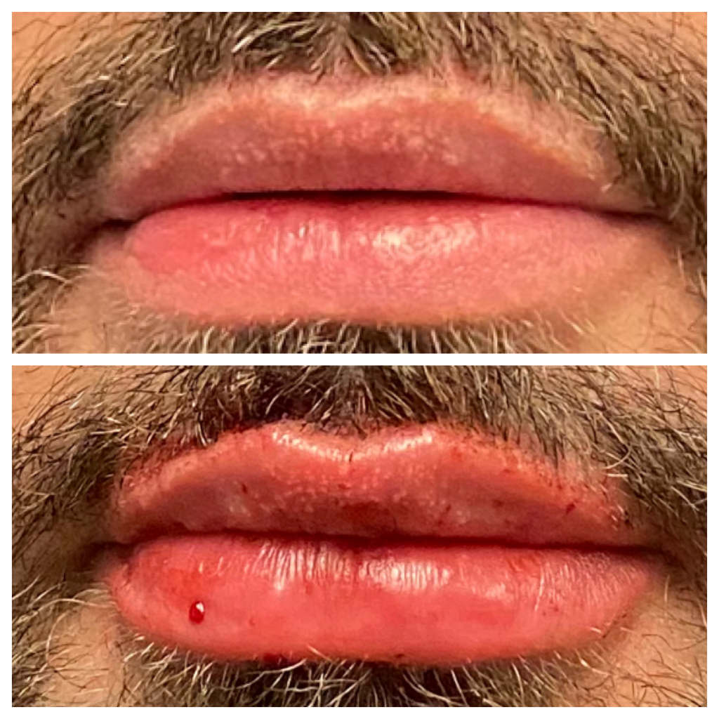 Lip Filler