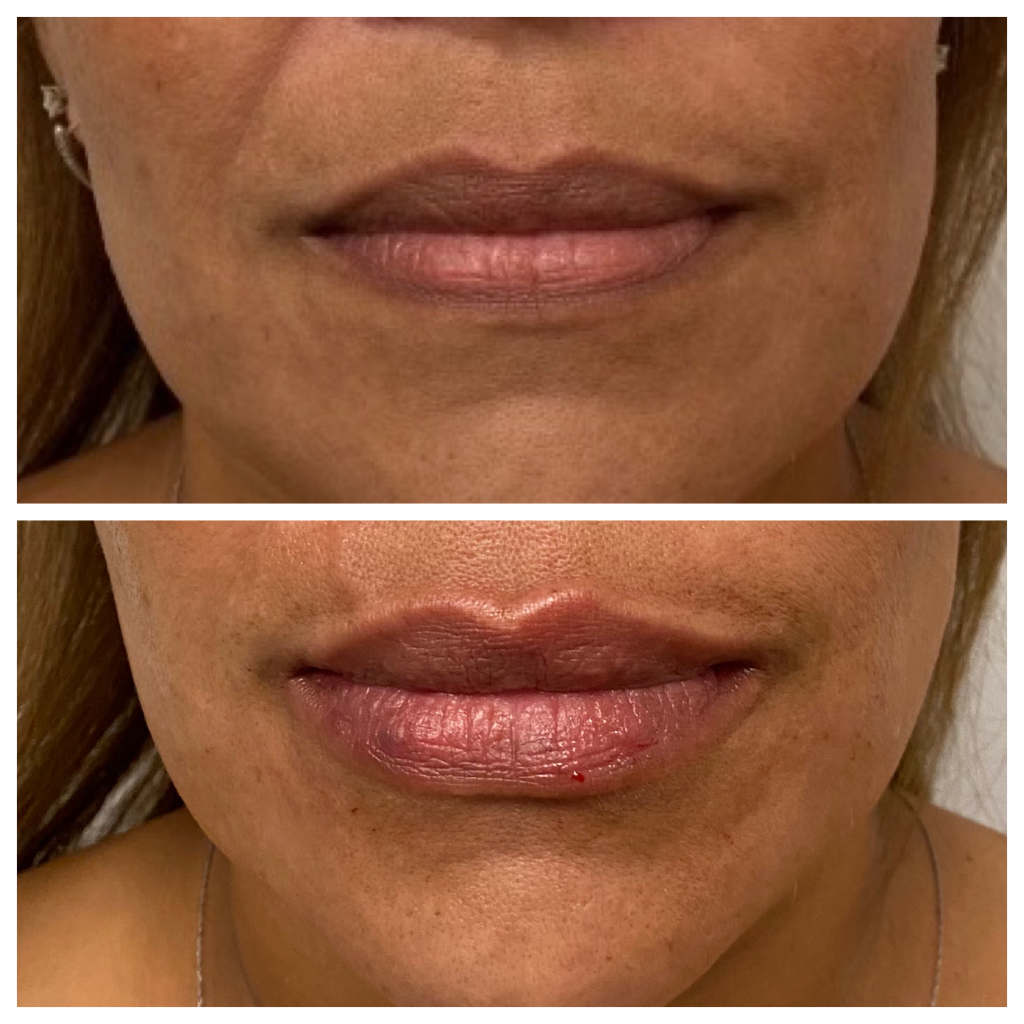Lip Filler Treatment with Versa