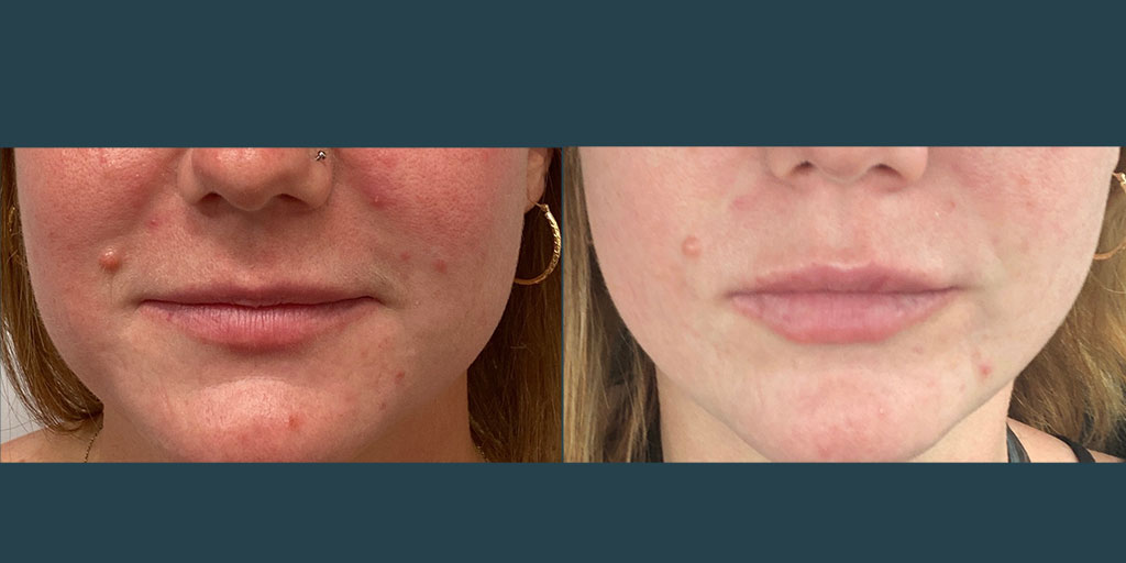 Lip Filler