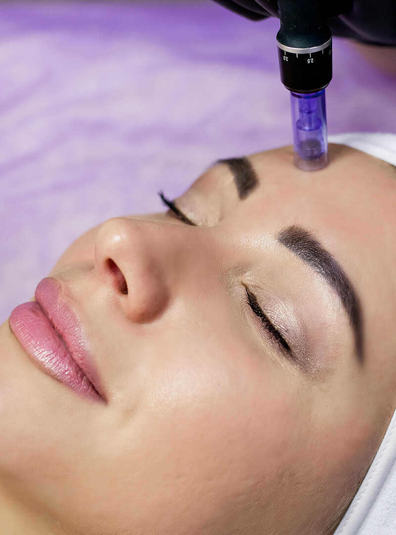 Microneedling with PRF