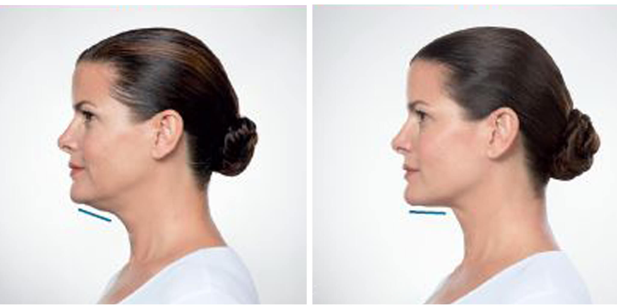 Kybella
