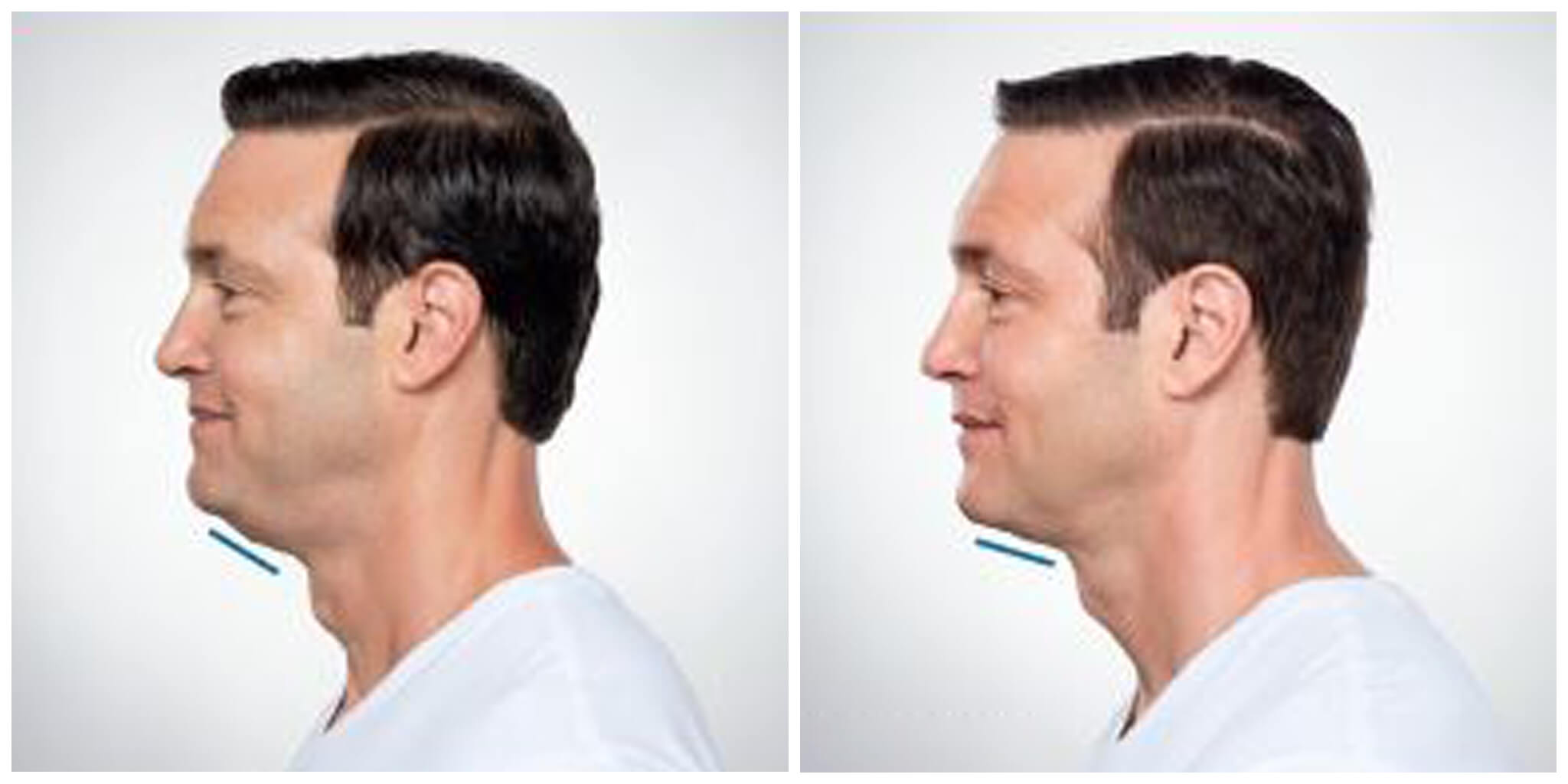 Kybella