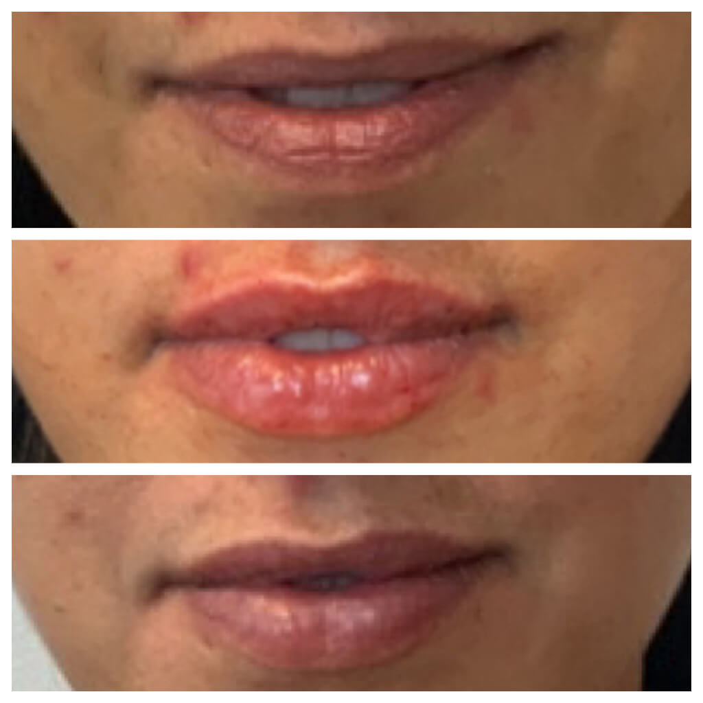 Lip Filler - before, after, and 1 month later with Restylane Refyne Treatment