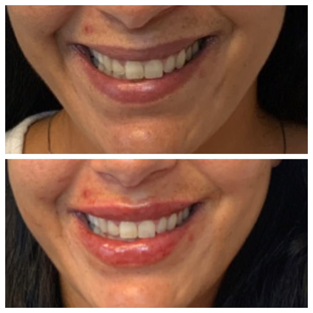 Lip Filler - Restylane Refyne