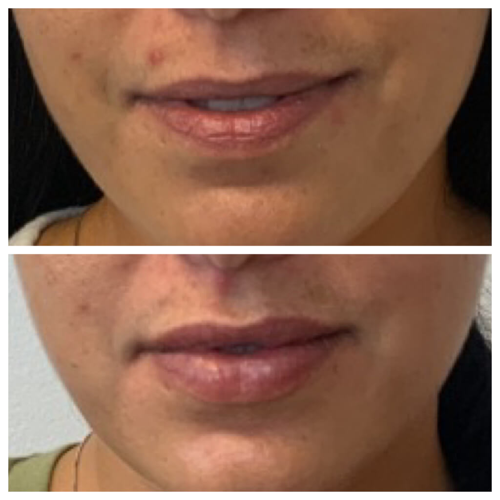 Lip Filler - 1 month after Restylane Refyne Treatment