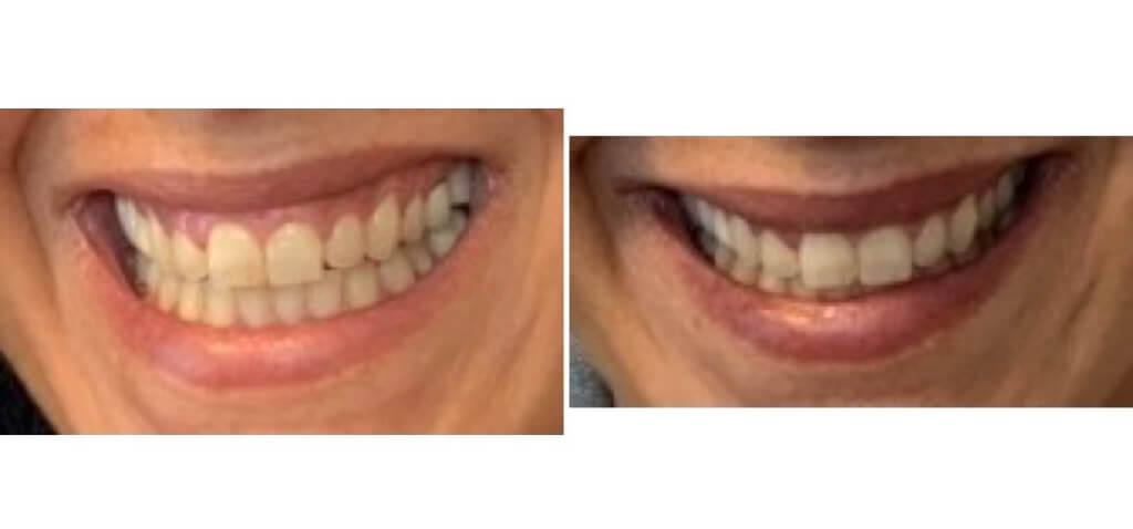 Botox - Lip Flip and Gummy Smile