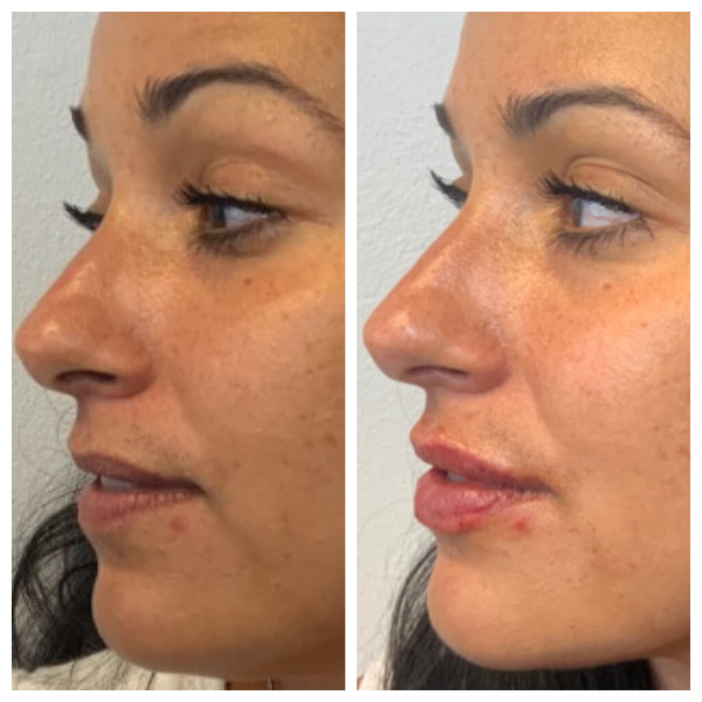 Lip Filler - Restylane Refyne