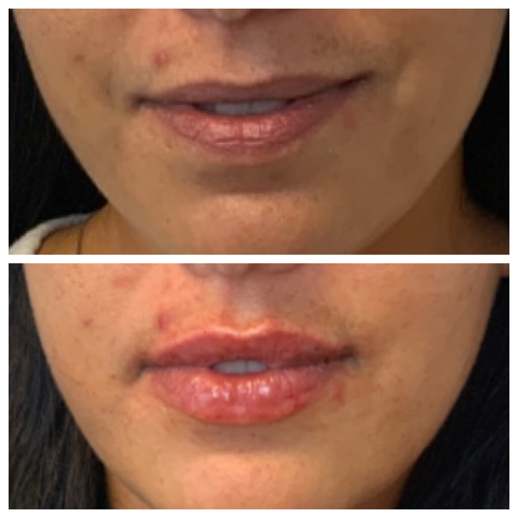 Lip Filler - Restylane Refyne