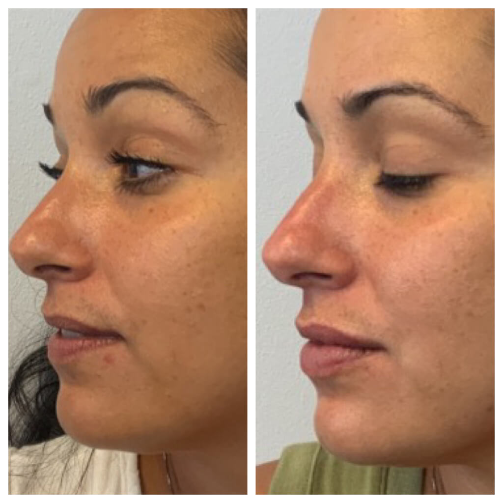 Lip Filler - 1 month after Restylane Refyne Treatment
