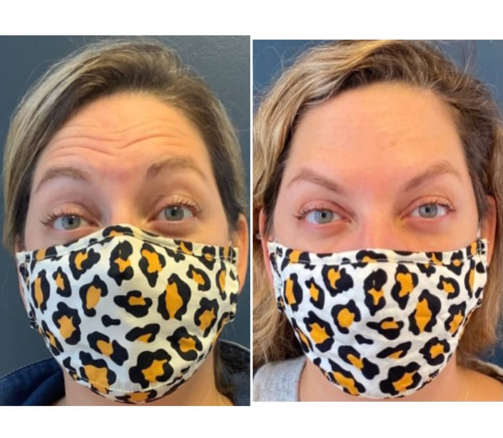 Botox - Forehead Wrinkles