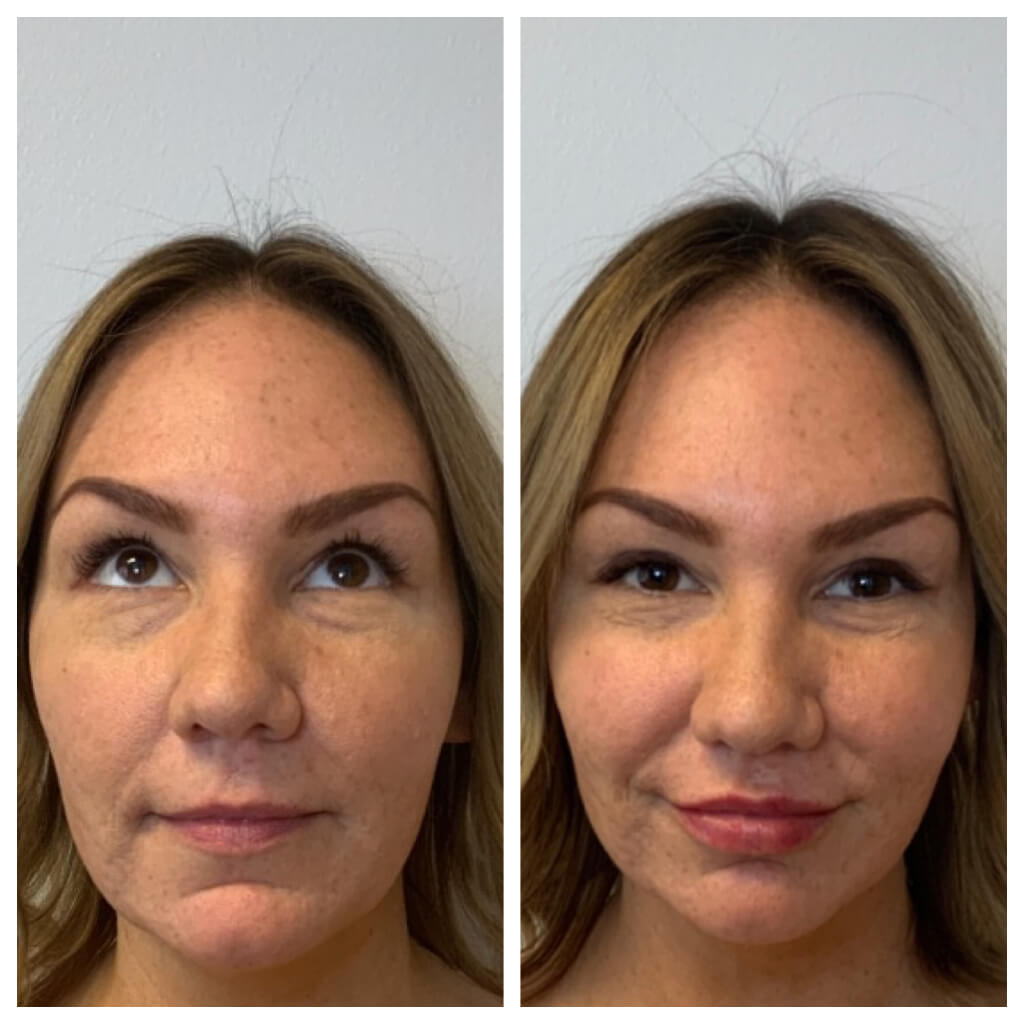 Lip Filler - Versa Filler