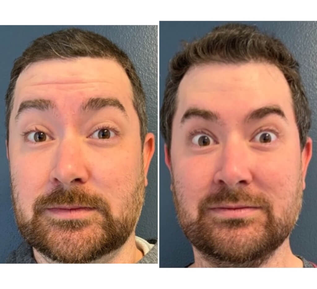 Botox - Forehead Wrinkles