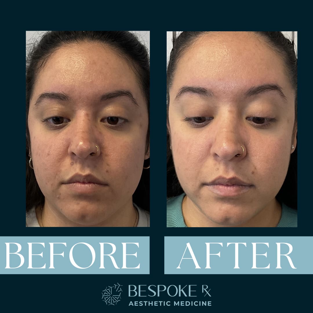 PRX Derm Perfexion