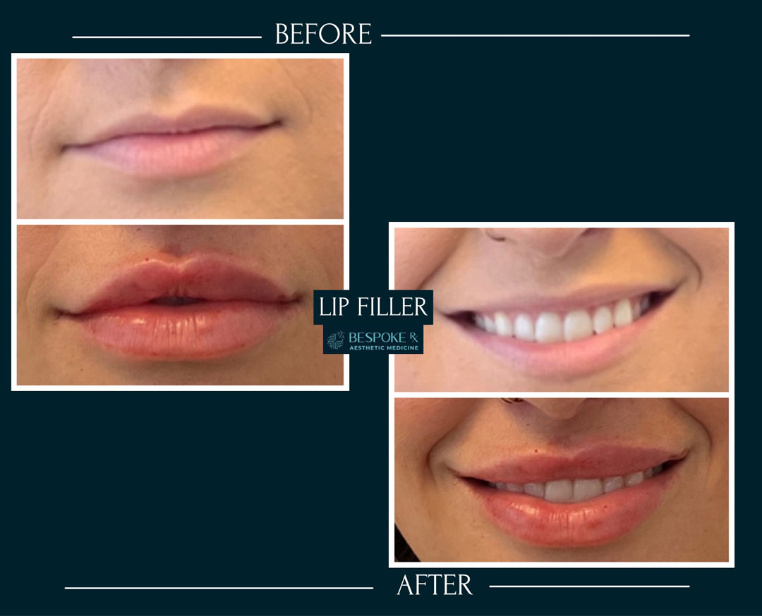Lip Filler - 4 treatments over 20 months
