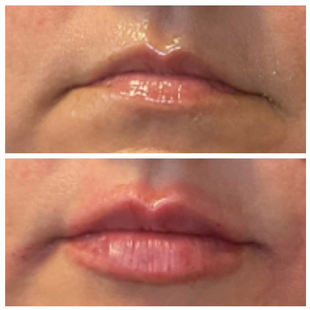 Lip Augmentation (lip filler)