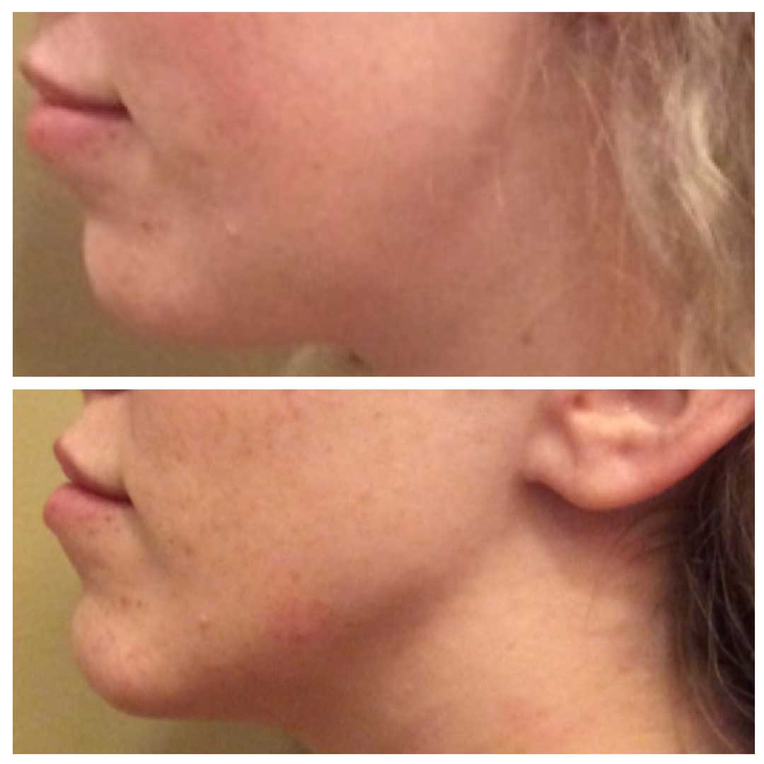 Jawline Filler