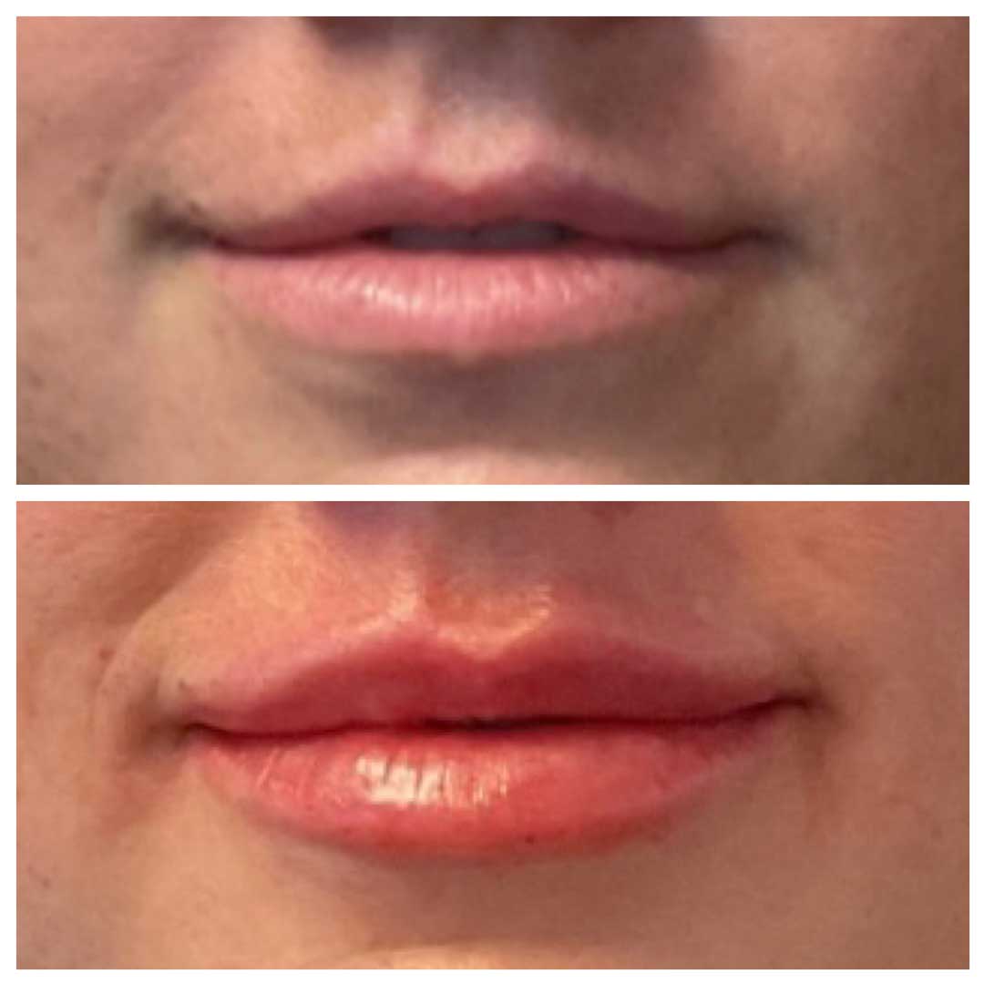 Lip Augmentation (lip filler)
