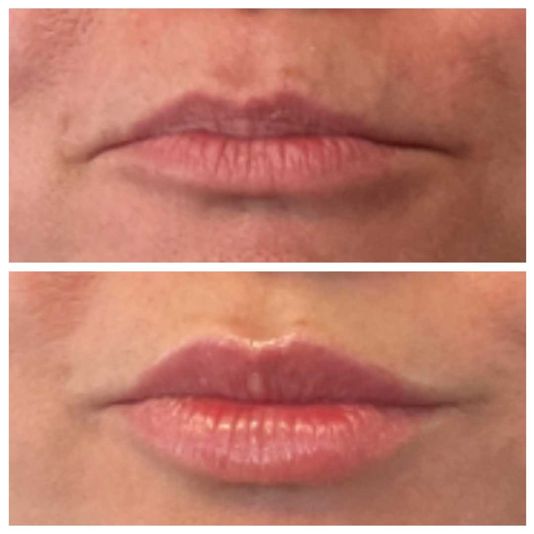 Lip Augmentation (lip filler)