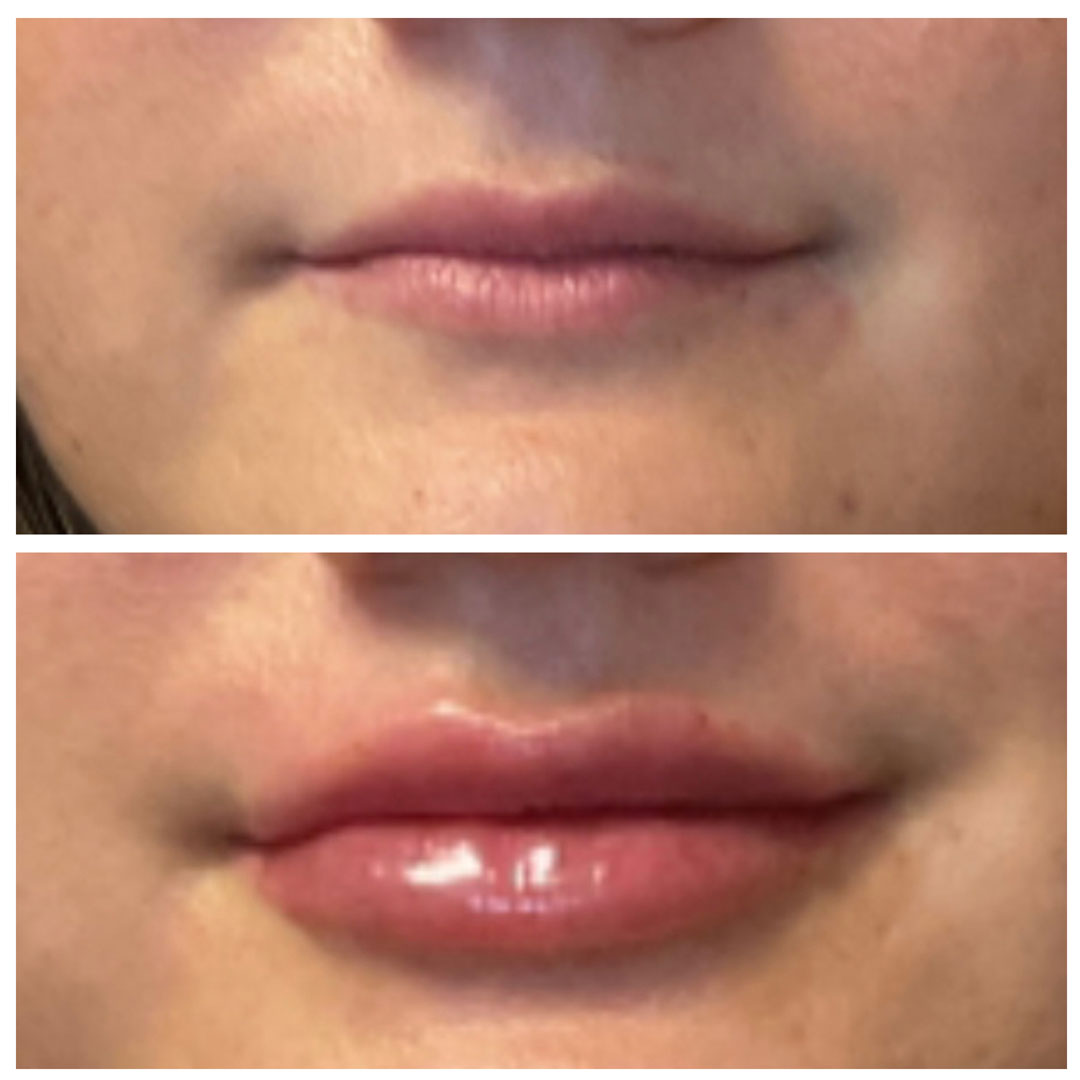 Lip augmentation (lip filler)