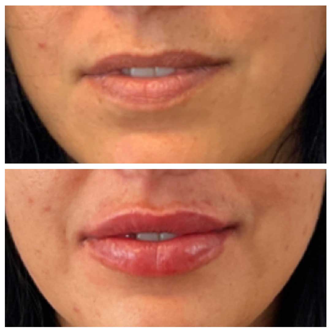 Lip Filler - 2 treatments over 9 months
