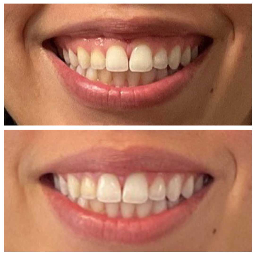 Gummy smile & lip flip treatment with Botox