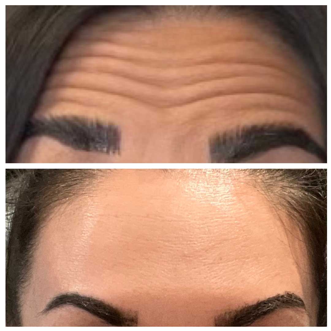 Forehead Treatment - Botox/Dysport