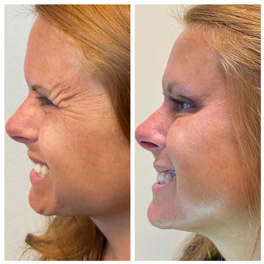 Crow's Feet Treatment - Botox/Dysport
