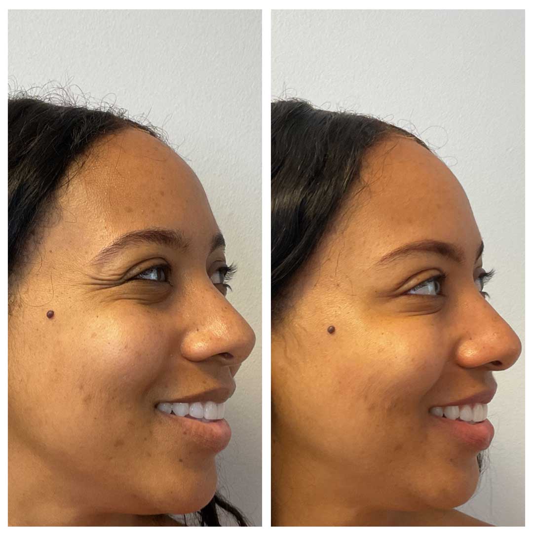 Crow's Feet Treatment - Botox/Dysport