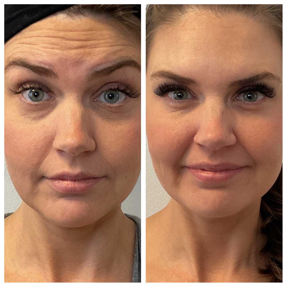 Forehead and Frown Lines Treatment - Botox/Dysport