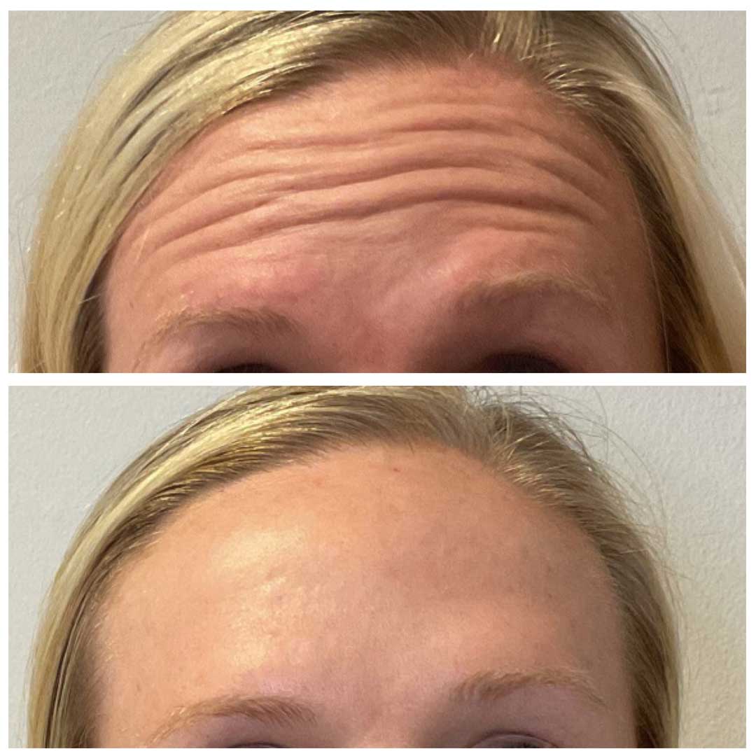 Forehead and Frown Lines Treatment - Botox/Dysport