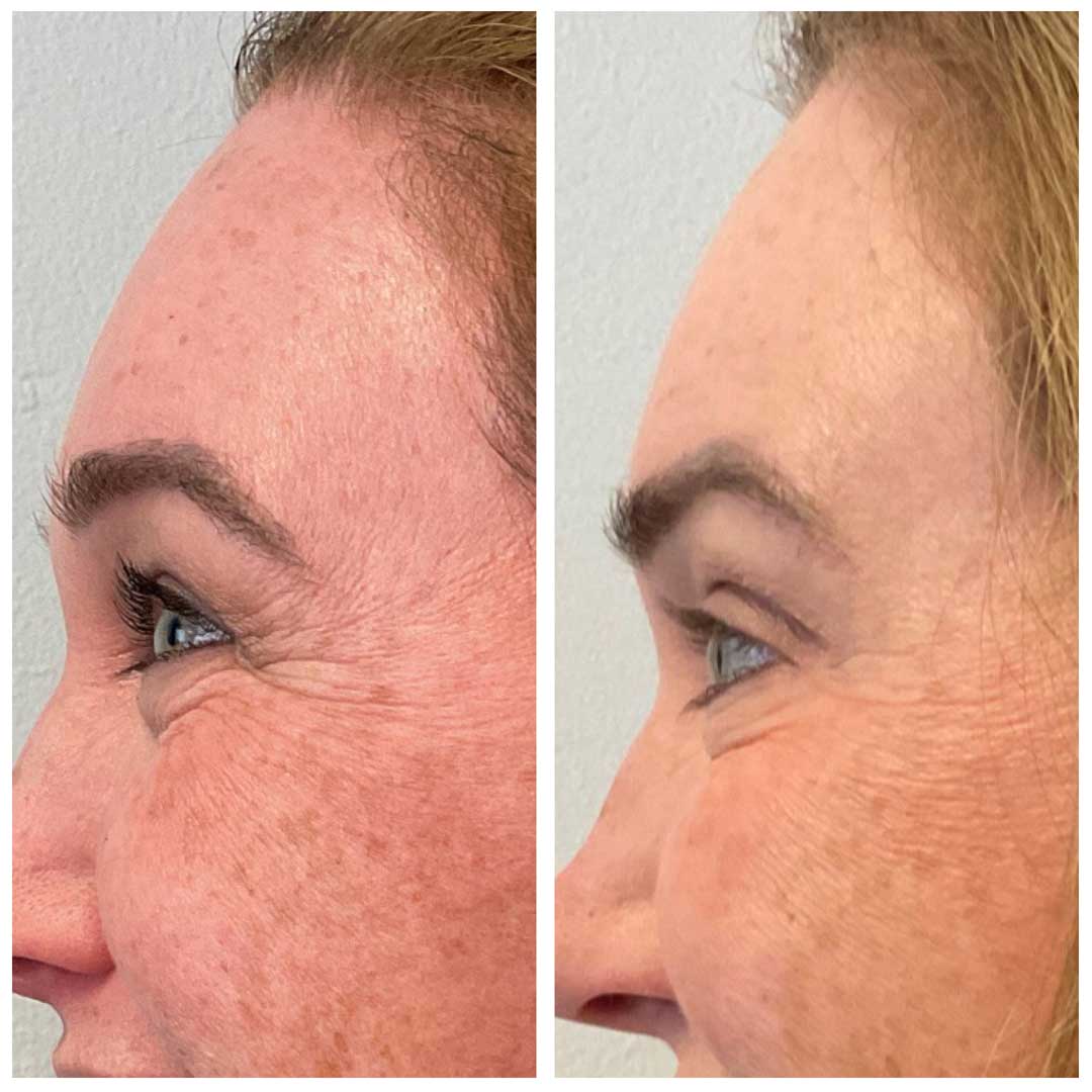 Crow's Feet Treatment - Botox/Dysport