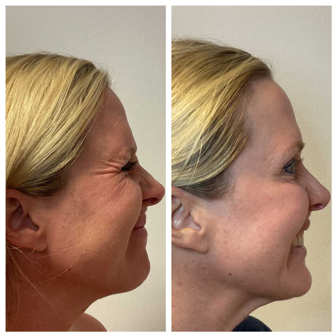 Crow's Feet Treatment - Botox/Dysport