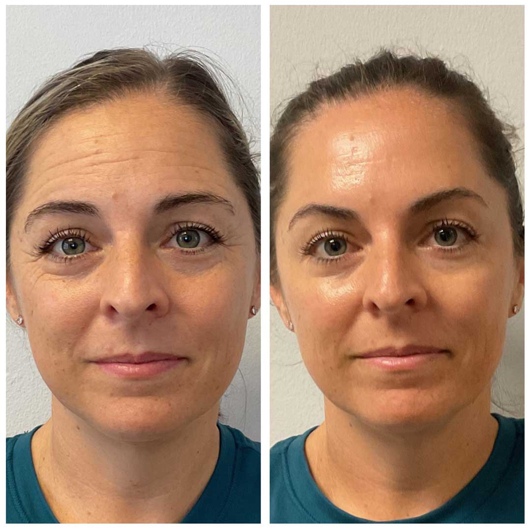 Frown Lines, Forehead, & Crows Feet treatment - Botox/Dysport